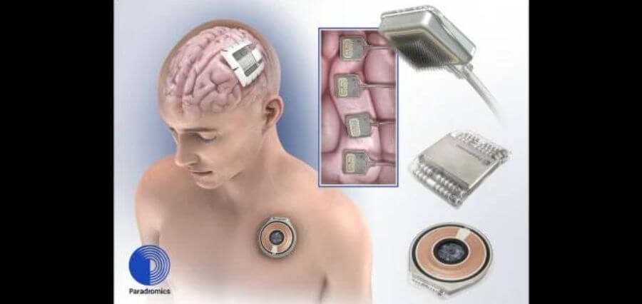 Brain Implant Company Paradromics Launches Patient Registry Ahead of Human Trial